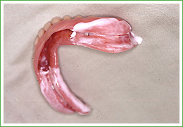 入れ歯（義歯）の適合状態2